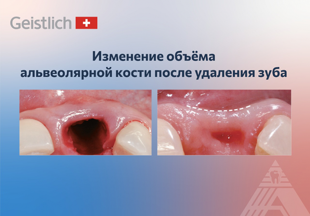 Изменения объёма альвеолярной кости после удаления зуба