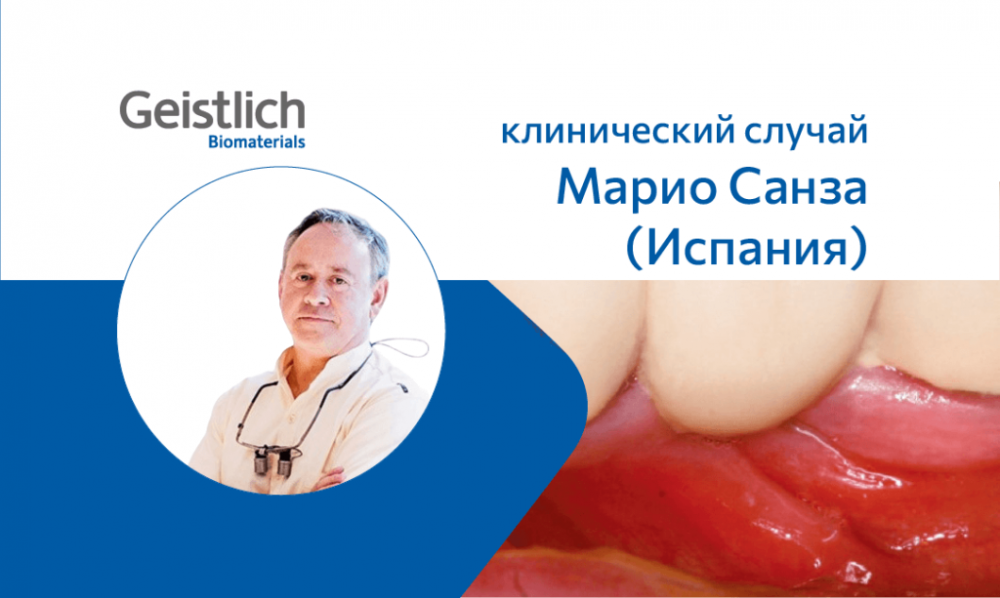 Увеличение зоны кератинизированной десны в области ортопедических конструкций