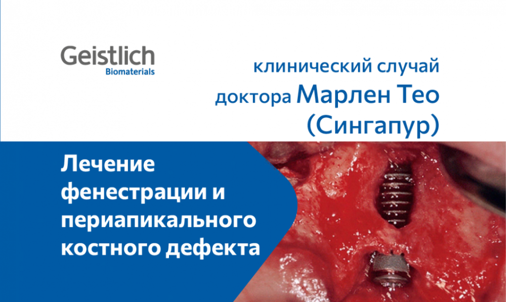 Аугментация костной ткани с использованием Geistlich Bio-Oss