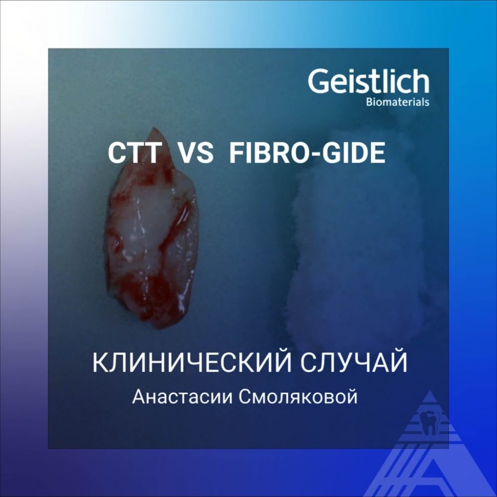 Geistlich Fibro-Gide позволяет добиться результатов, сопоставимых с СТТ