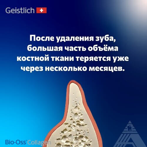 Спонтанное заживление или обычная коллагеновая губка не способны предотвратить потерю объёма