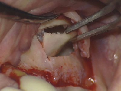 Антон Герасимов. Открытый синус-лифтинг. Уверенность в результате. — клинический пример